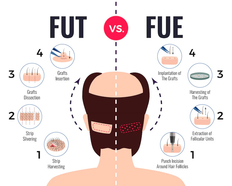 Hair Transplant Success Rate - FUE Vs FUT