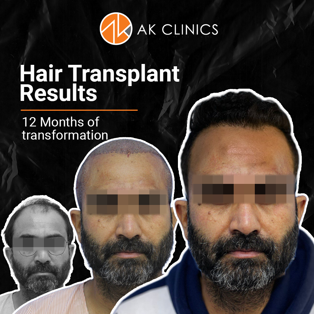 hair transplant result at AK Clinics