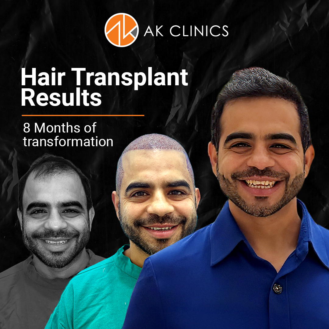 hair transplant result at AK Clinics