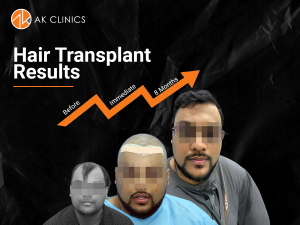 hair transplant result at AK Clinics