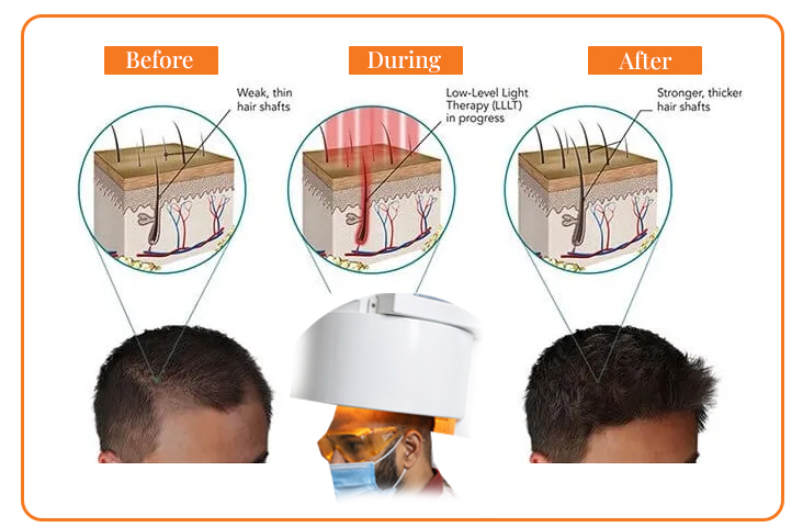 before, During & after LLLT