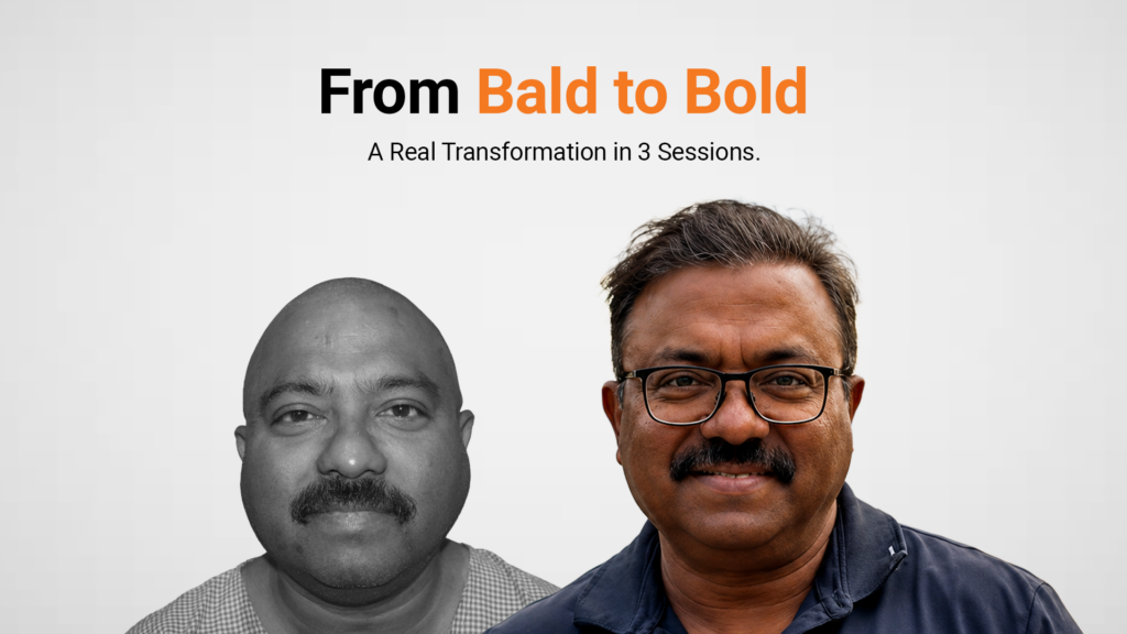 Debobroto hair transplant