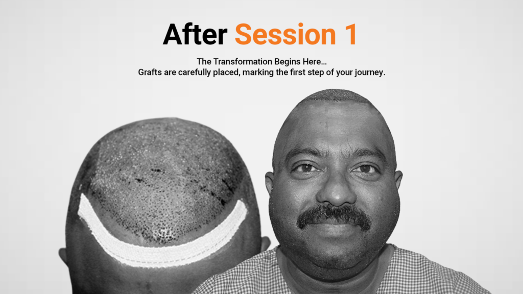 Hair transplant Session 1 result