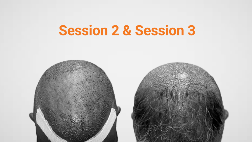 Hair transplant Session 2 progress