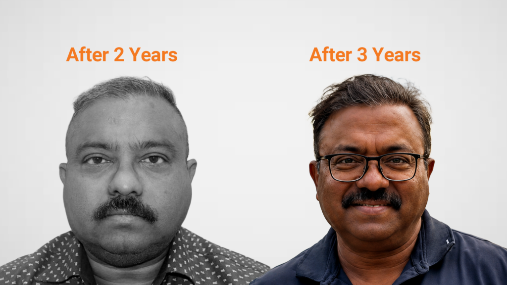 Hair transplant Session 3 final result